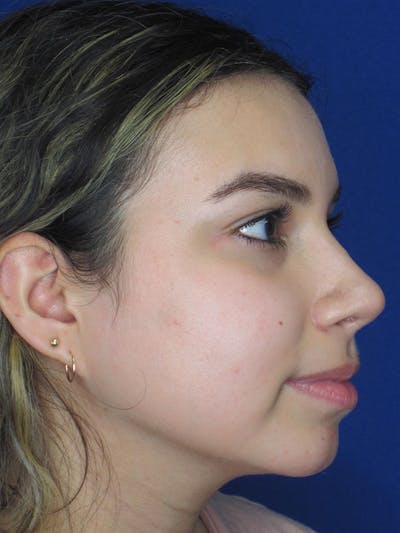 Rhinoplasty Before & After Gallery - Patient 92108549 - Image 4
