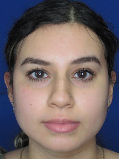 Rhinoplasty Before & After Gallery - Patient 92108549 - Image 1
