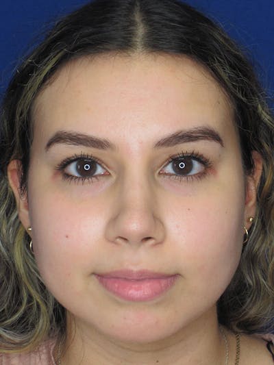 Rhinoplasty Before & After Gallery - Patient 92108549 - Image 2