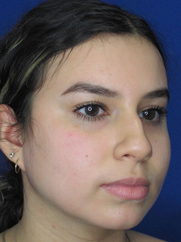 Rhinoplasty Before & After Gallery - Patient 92108549 - Image 5