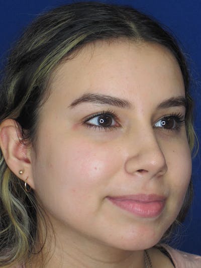 Rhinoplasty Before & After Gallery - Patient 92108549 - Image 6