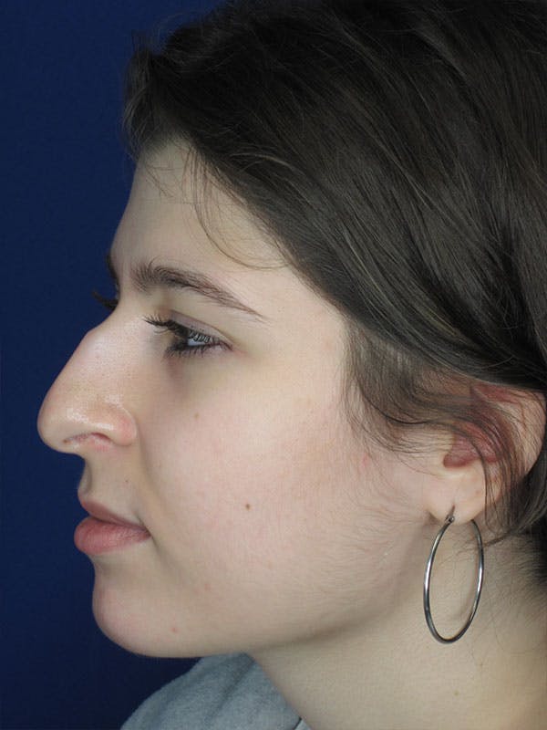Rhinoplasty Before & After Gallery - Patient 92111697 - Image 3