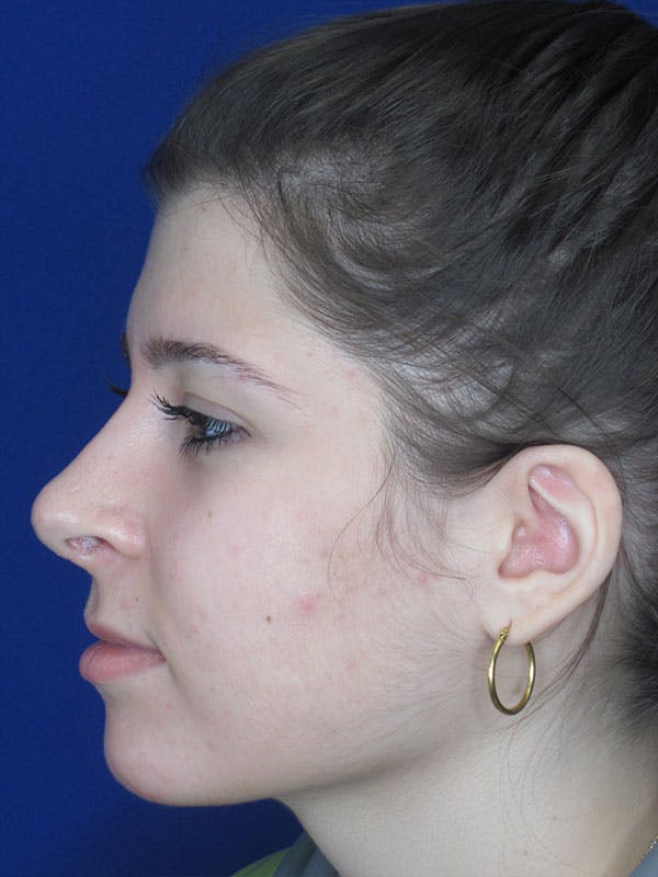Rhinoplasty Before & After Gallery - Patient 92111697 - Image 4