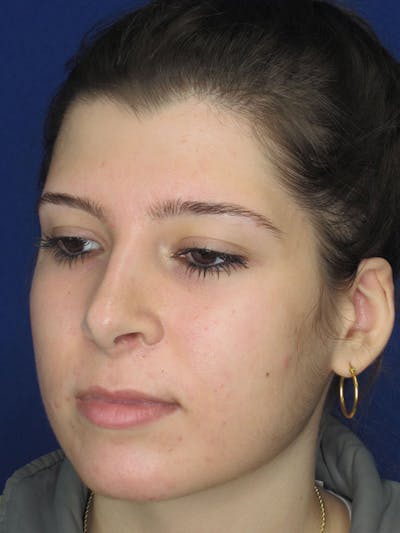Rhinoplasty Before & After Gallery - Patient 92111697 - Image 6