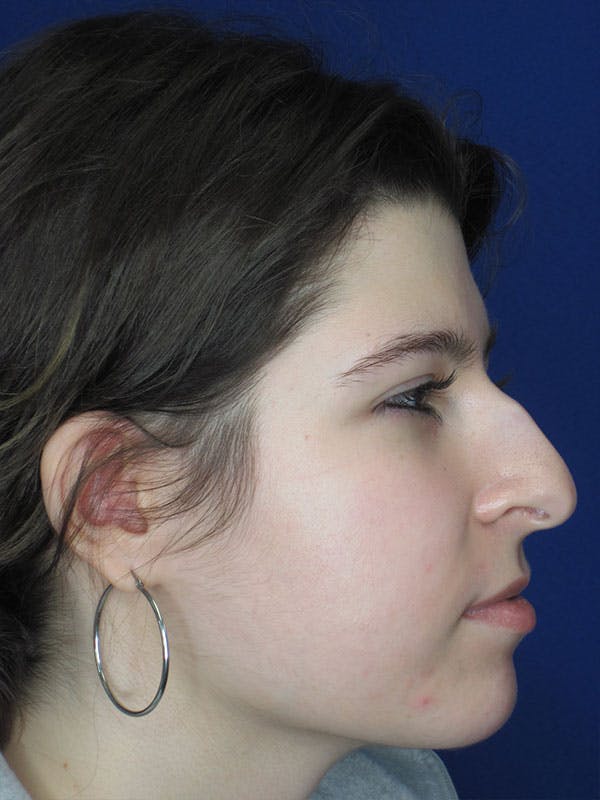 Rhinoplasty Before & After Gallery - Patient 92111697 - Image 7