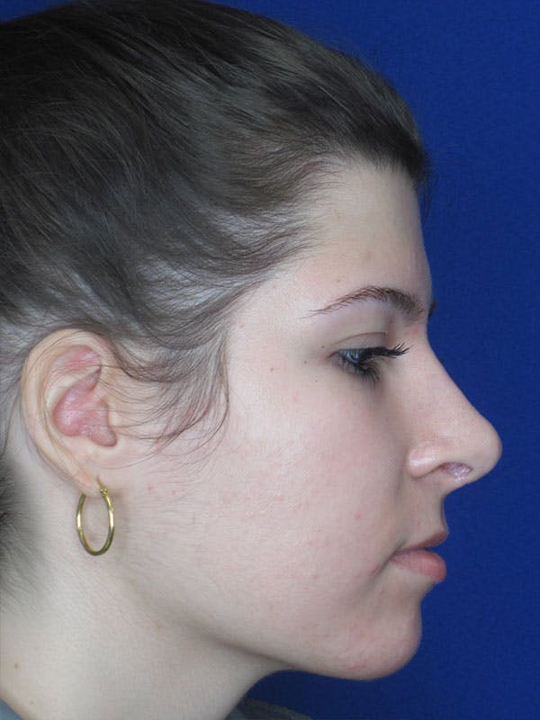 Rhinoplasty Before & After Gallery - Patient 92111697 - Image 8
