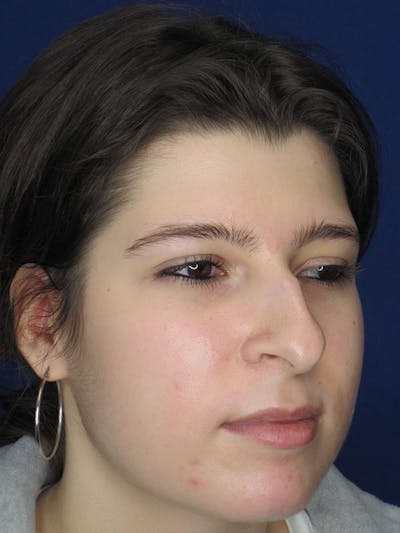 Rhinoplasty Before & After Gallery - Patient 92111697 - Image 1