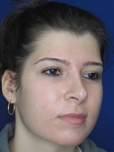 Rhinoplasty Before & After Gallery - Patient 92111697 - Image 2