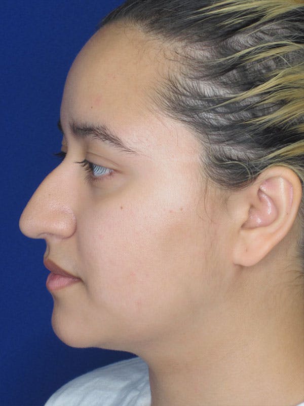 Rhinoplasty Before & After Gallery - Patient 92111706 - Image 1