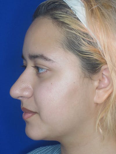 Rhinoplasty Before & After Gallery - Patient 92111706 - Image 2