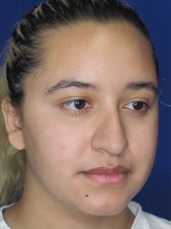 Rhinoplasty Before & After Gallery - Patient 92111706 - Image 3