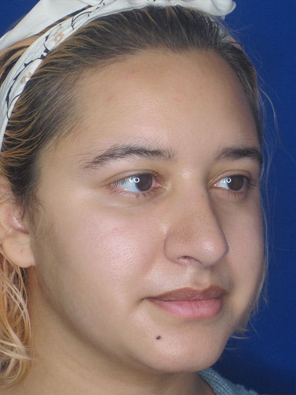 Rhinoplasty Before & After Gallery - Patient 92111706 - Image 4