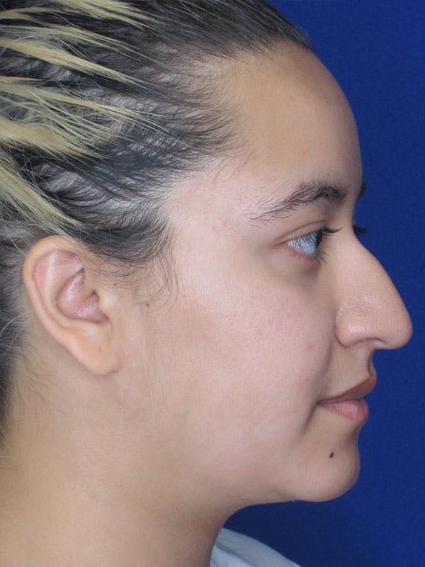 Rhinoplasty Before & After Gallery - Patient 92111706 - Image 5