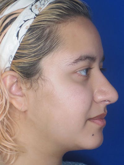 Rhinoplasty Before & After Gallery - Patient 92111706 - Image 6