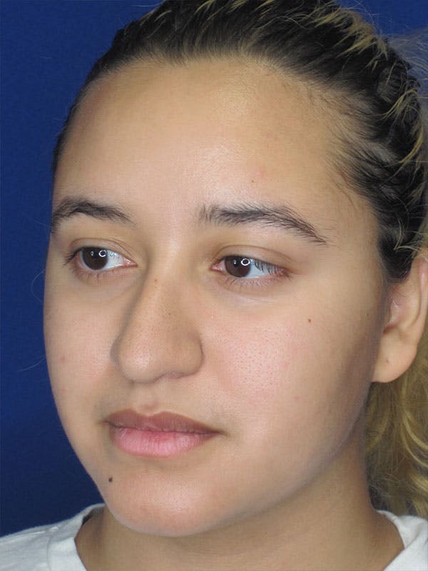 Rhinoplasty Before & After Gallery - Patient 92111706 - Image 7