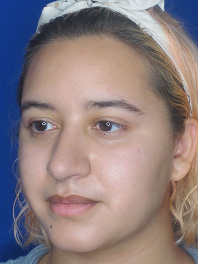 Rhinoplasty Before & After Gallery - Patient 92111706 - Image 8