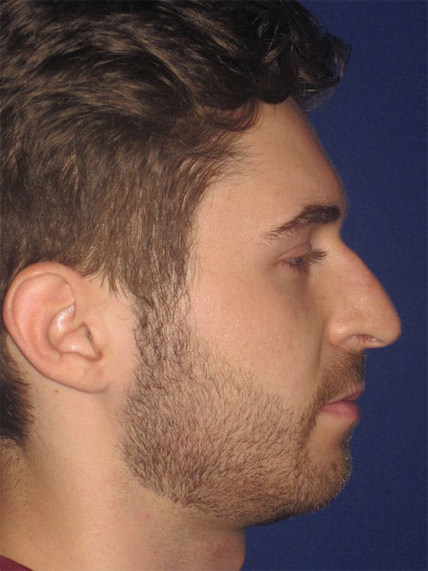 Rhinoplasty Before & After Gallery - Patient 92111713 - Image 1