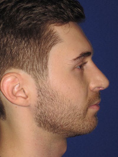 Rhinoplasty Before & After Gallery - Patient 92111713 - Image 2