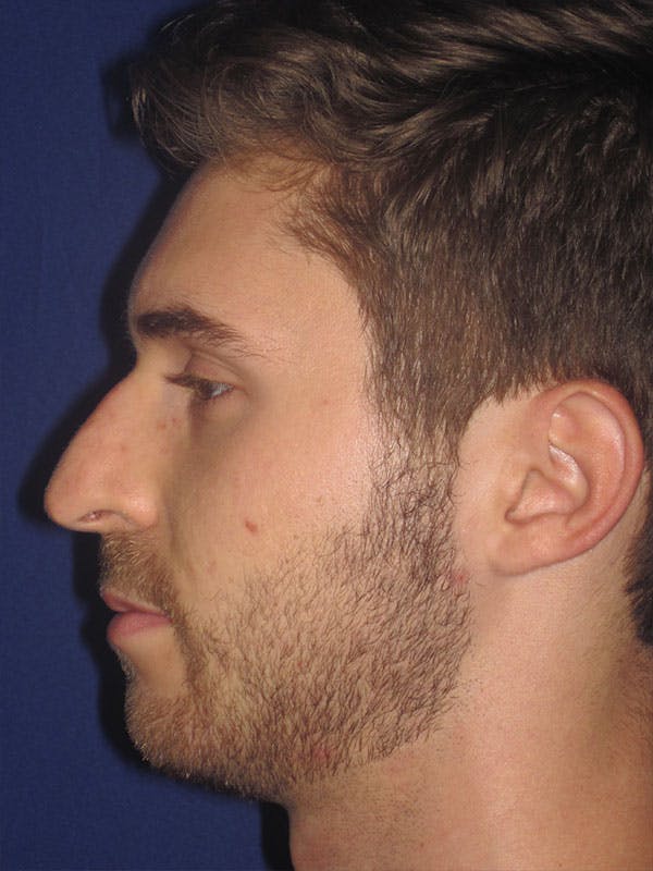 Rhinoplasty Before & After Gallery - Patient 92111713 - Image 3
