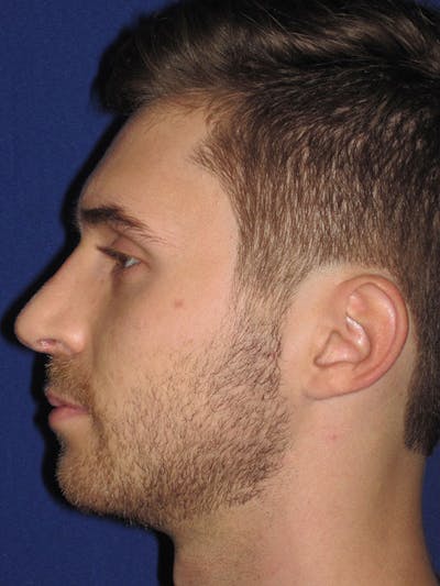 Rhinoplasty Before & After Gallery - Patient 92111713 - Image 4