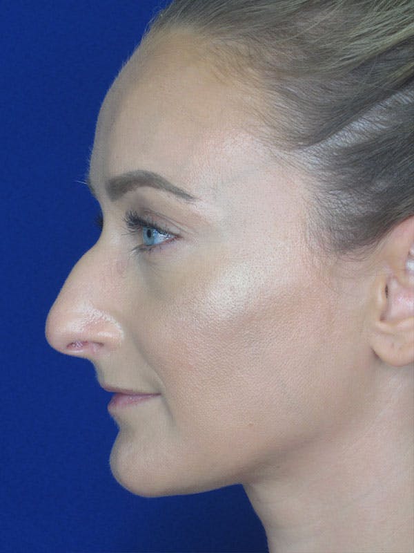 Rhinoplasty Before & After Gallery - Patient 92111715 - Image 1