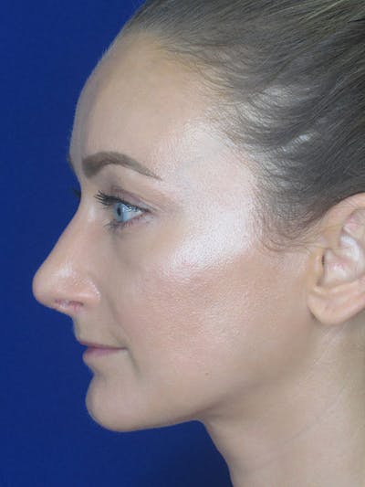Rhinoplasty Before & After Gallery - Patient 92111715 - Image 2