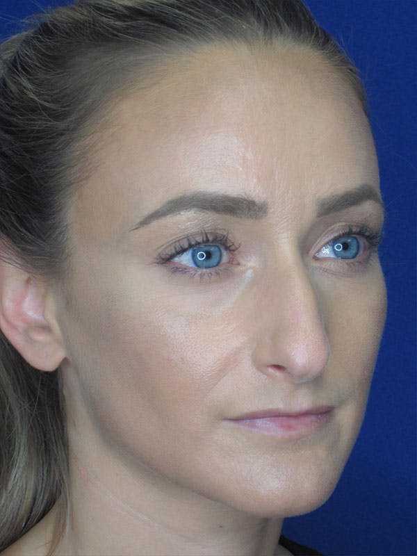 Rhinoplasty Before & After Gallery - Patient 92111715 - Image 3