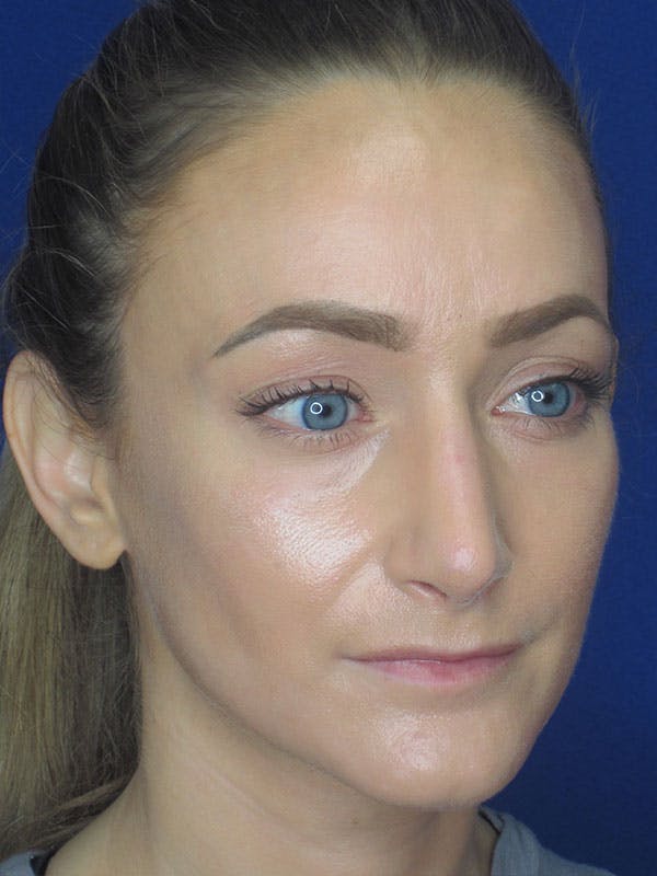 Rhinoplasty Before & After Gallery - Patient 92111715 - Image 4
