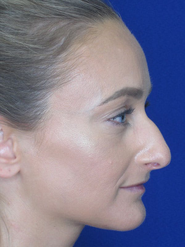 Rhinoplasty Before & After Gallery - Patient 92111715 - Image 5