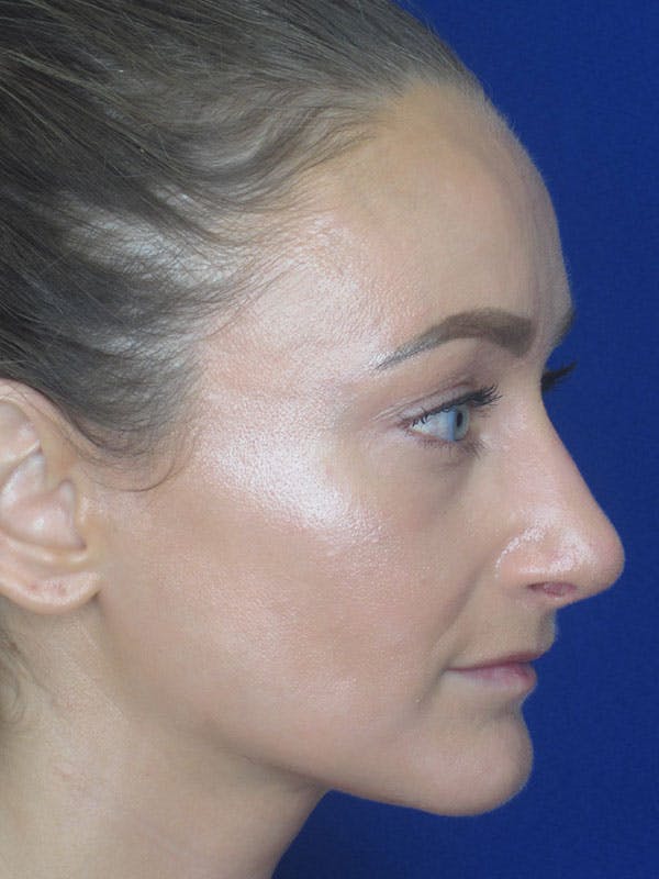 Rhinoplasty Before & After Gallery - Patient 92111715 - Image 6