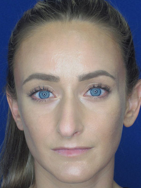 Rhinoplasty Before & After Gallery - Patient 92111715 - Image 7