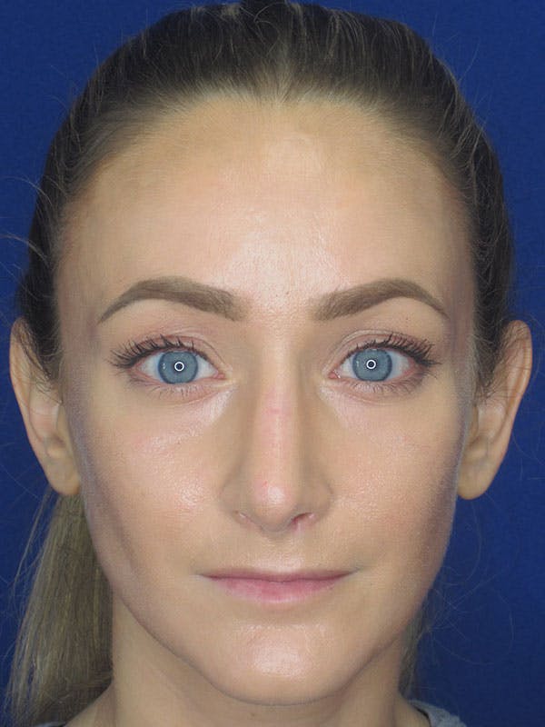 Rhinoplasty Before & After Gallery - Patient 92111715 - Image 8