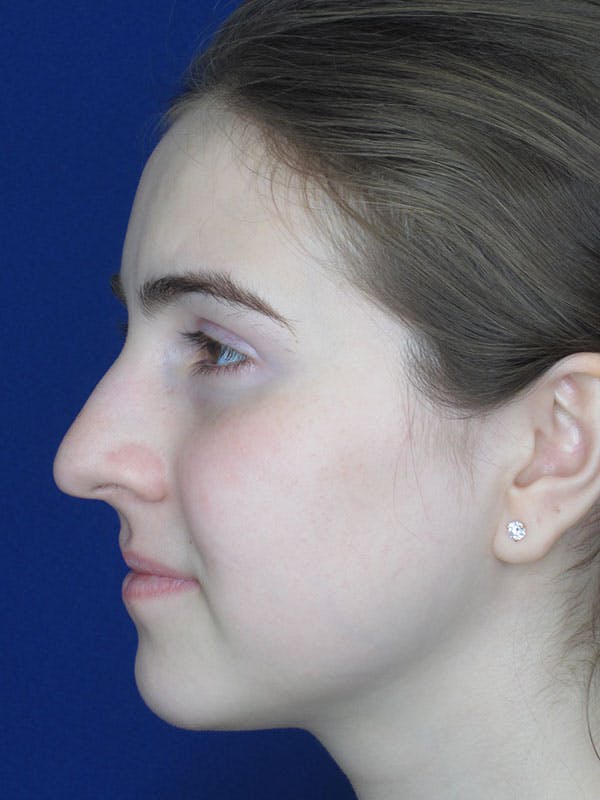 Rhinoplasty Before & After Gallery - Patient 92111719 - Image 1
