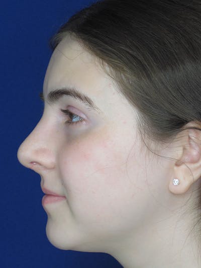 Rhinoplasty Before & After Gallery - Patient 92111719 - Image 2