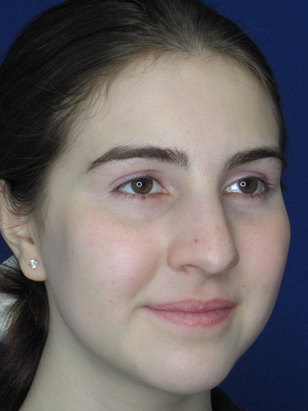 Rhinoplasty Before & After Gallery - Patient 92111719 - Image 3