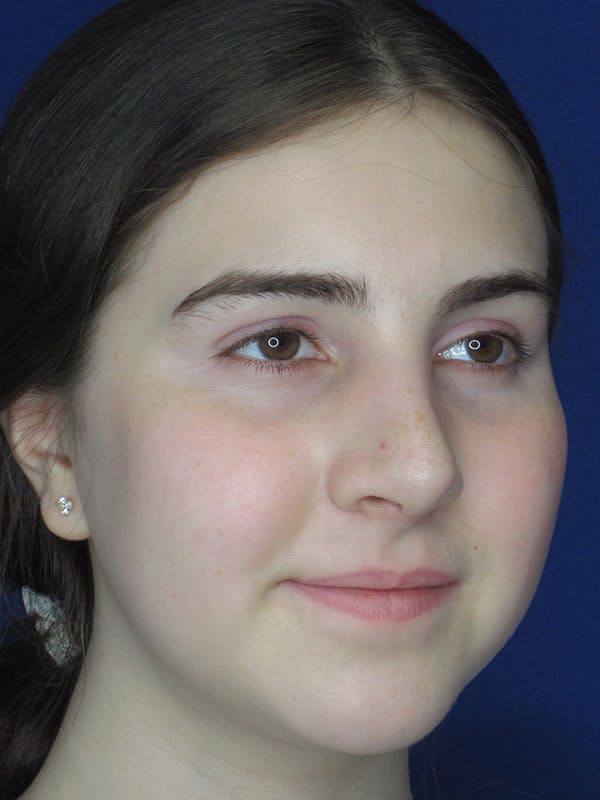 Rhinoplasty Before & After Gallery - Patient 92111719 - Image 4