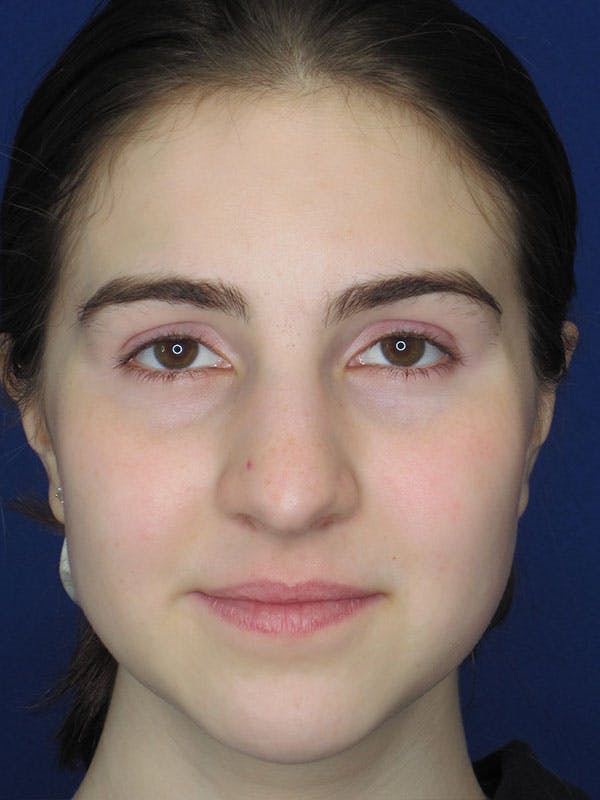 Rhinoplasty Before & After Gallery - Patient 92111719 - Image 5