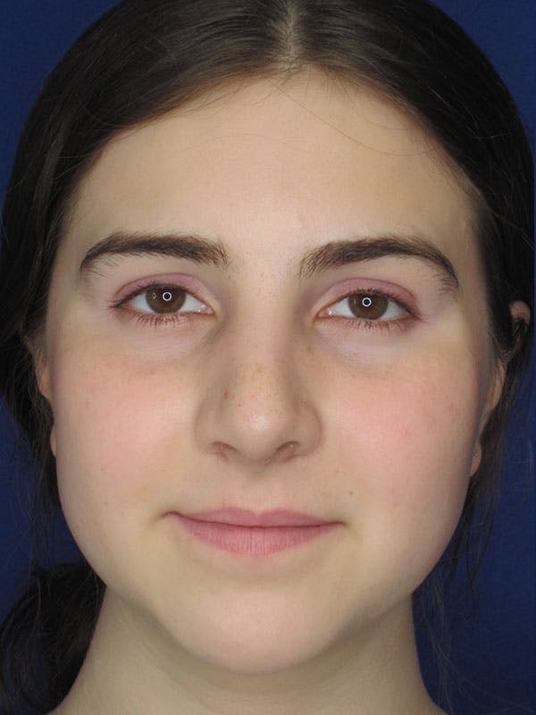 Rhinoplasty Before & After Gallery - Patient 92111719 - Image 6