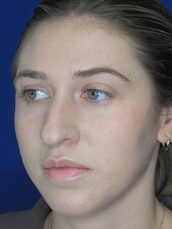 Rhinoplasty Before & After Gallery - Patient 92111726 - Image 1