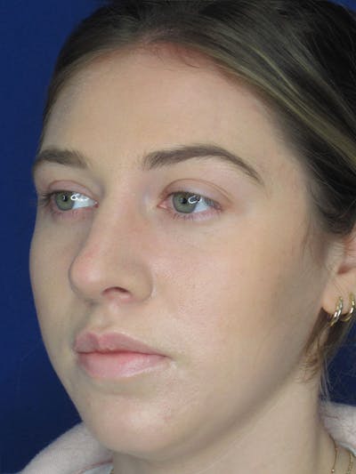 Rhinoplasty Before & After Gallery - Patient 92111726 - Image 2