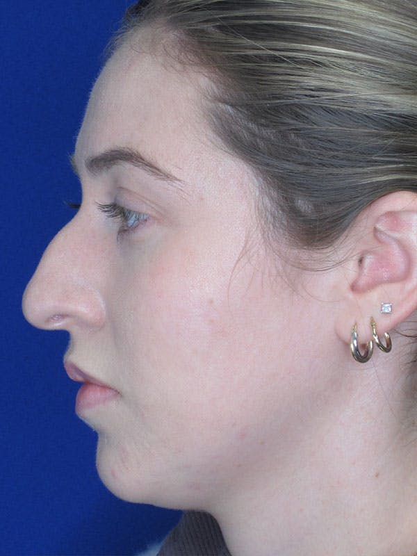 Rhinoplasty Before & After Gallery - Patient 92111726 - Image 3