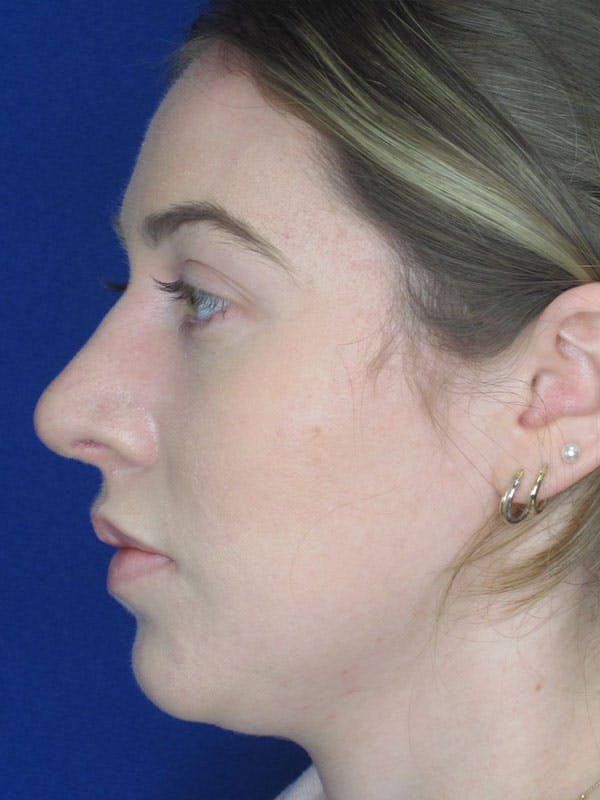 Rhinoplasty Before & After Gallery - Patient 92111726 - Image 4
