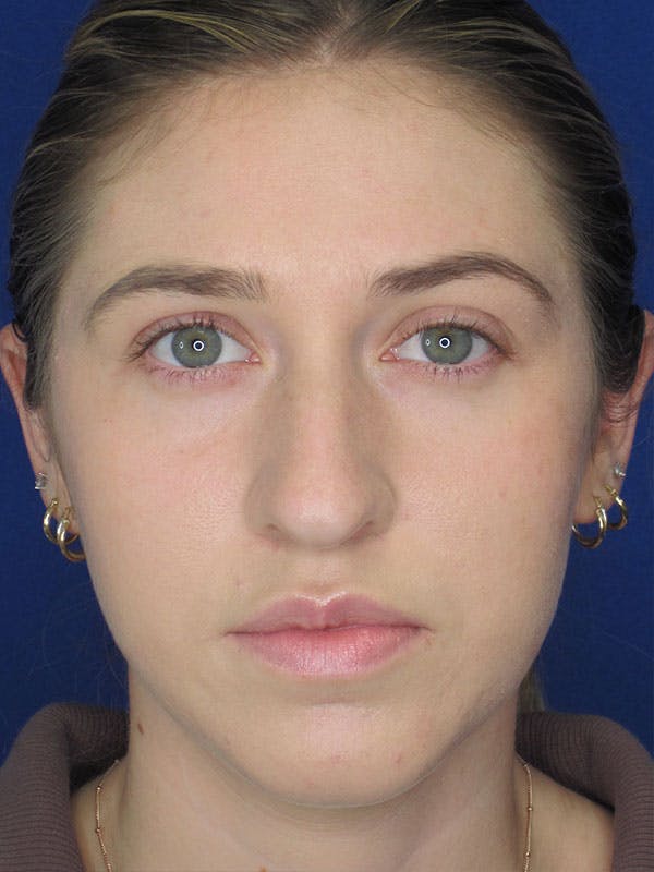 Rhinoplasty Before & After Gallery - Patient 92111726 - Image 5