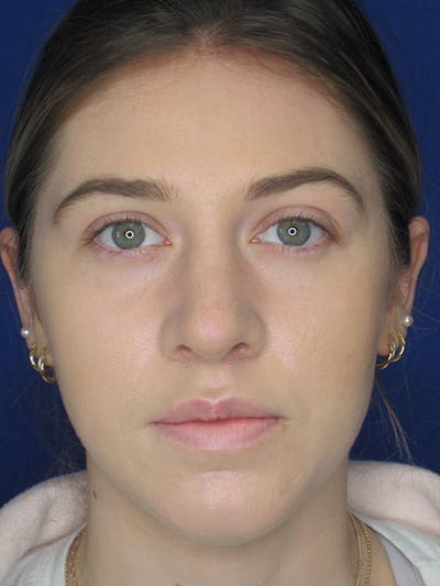 Rhinoplasty Before & After Gallery - Patient 92111726 - Image 6