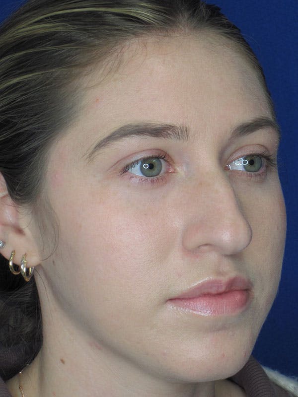 Rhinoplasty Before & After Gallery - Patient 92111726 - Image 7