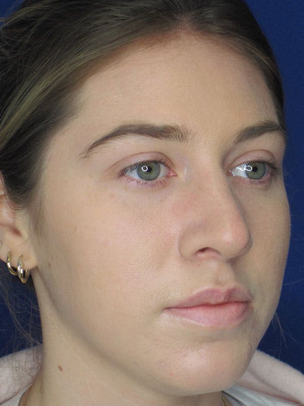 Rhinoplasty Before & After Gallery - Patient 92111726 - Image 8