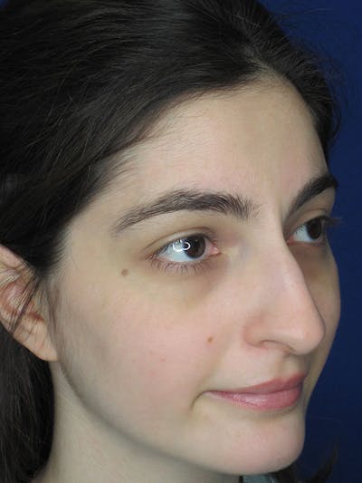 Rhinoplasty Before & After Gallery - Patient 92111732 - Image 1