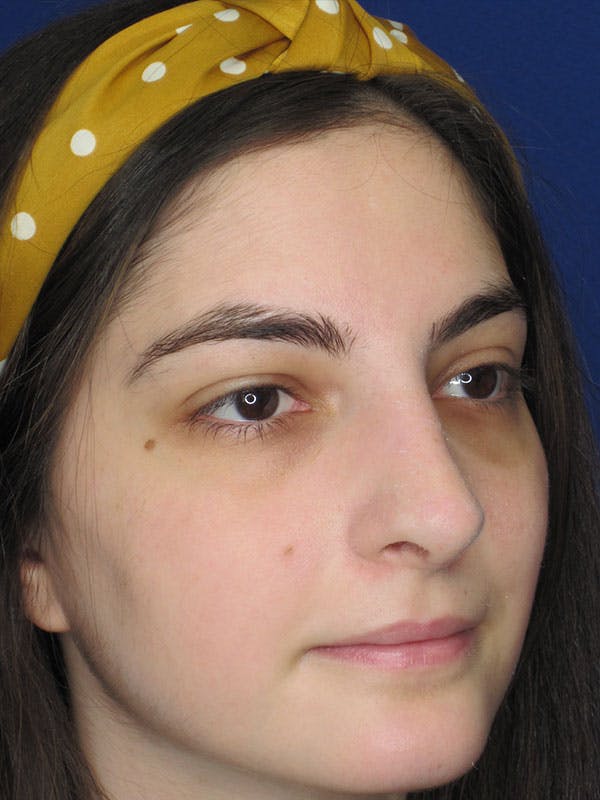 Rhinoplasty Before & After Gallery - Patient 92111732 - Image 2