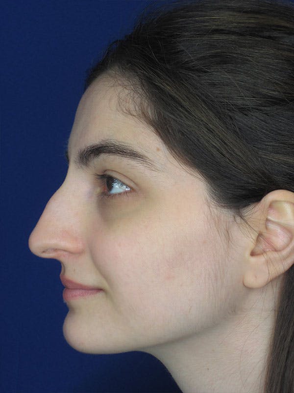 Rhinoplasty Before & After Gallery - Patient 92111732 - Image 3
