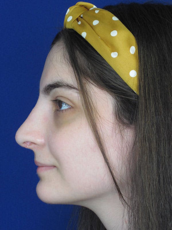 Rhinoplasty Before & After Gallery - Patient 92111732 - Image 4